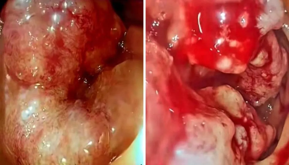 اسرار | تفاصيل صادمة- قصة مؤلمة تهز صنعاء.. طبيب يروي مأساة فتاة ظنت المرض بسيطا فخطفها السرطان قبل زفافها
