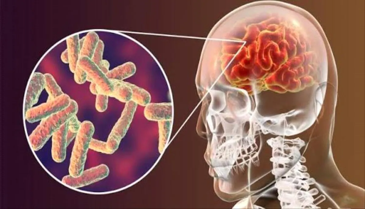 اسرار | بالتفاصيل- تحذير طبي عاجل من صنعاء يكشف أخطر مؤشرات الحمى الشوكية