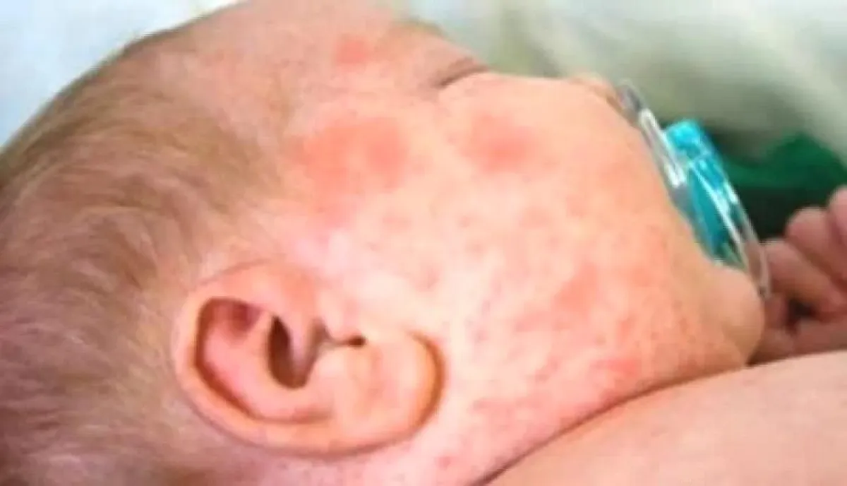 اسرار | بالارقام والتفاصيل- الحصبة يعاود الانتشار في حضرموت رغم خملات التطعيم