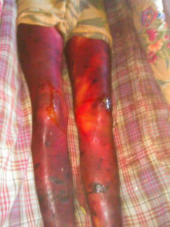 هذا ما يحدث في اليمن| الصور تتحدث عن  (اسرار) مجازر الحوثي.. شاهد صور مؤلمة جدا لأحد ضحايا التعذيب الوحشي للجماعة